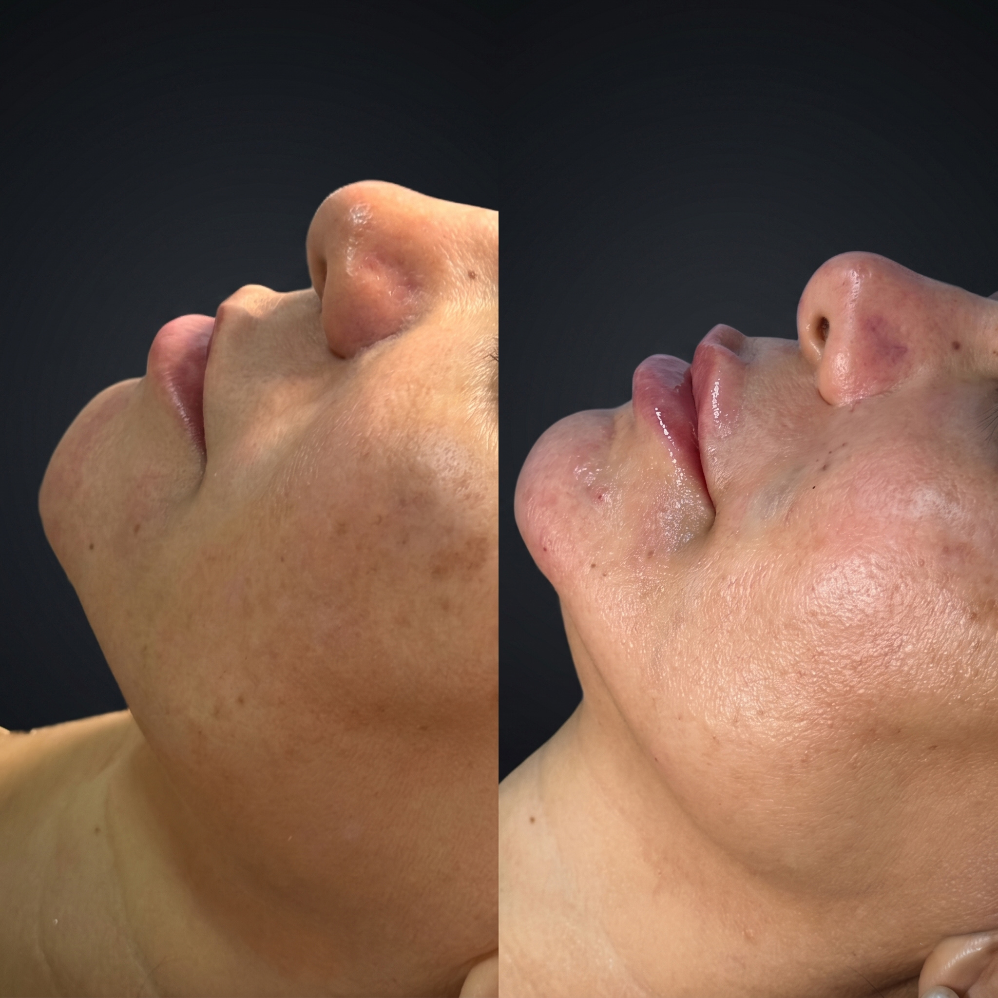 Antes e depois de suavização de expressão realizado pela esteticista Dra. Naiane Gonçalves em Sinop