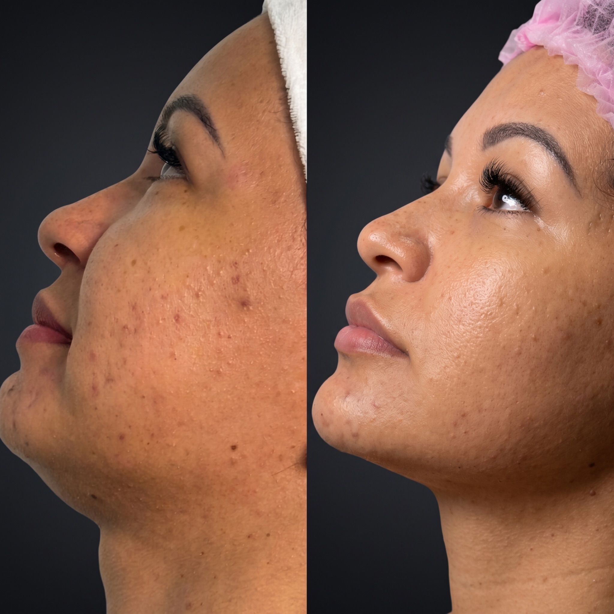 Antes e depois de suavização de expressão nas linhas do rosto realizado pela esteticista Dra. Naiane Gonçalves em Sinop